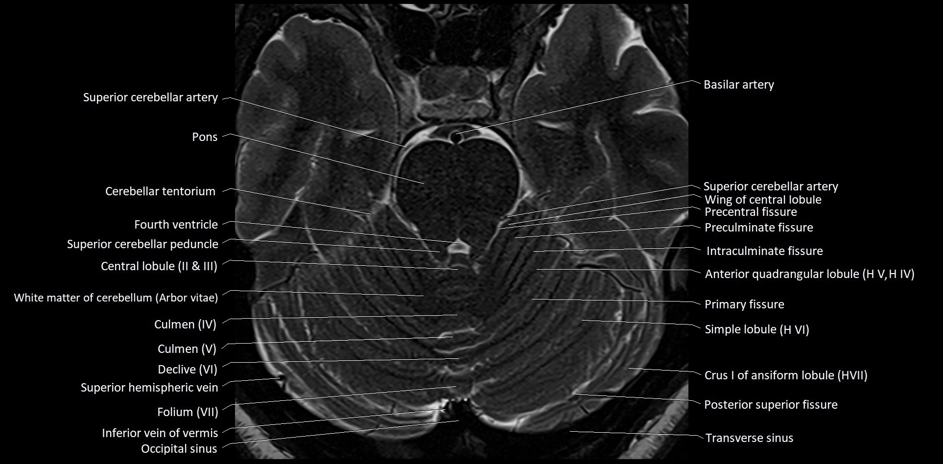 MRI Cerebellar anatomy High-resolution labelled 3T MRI image 19.webp